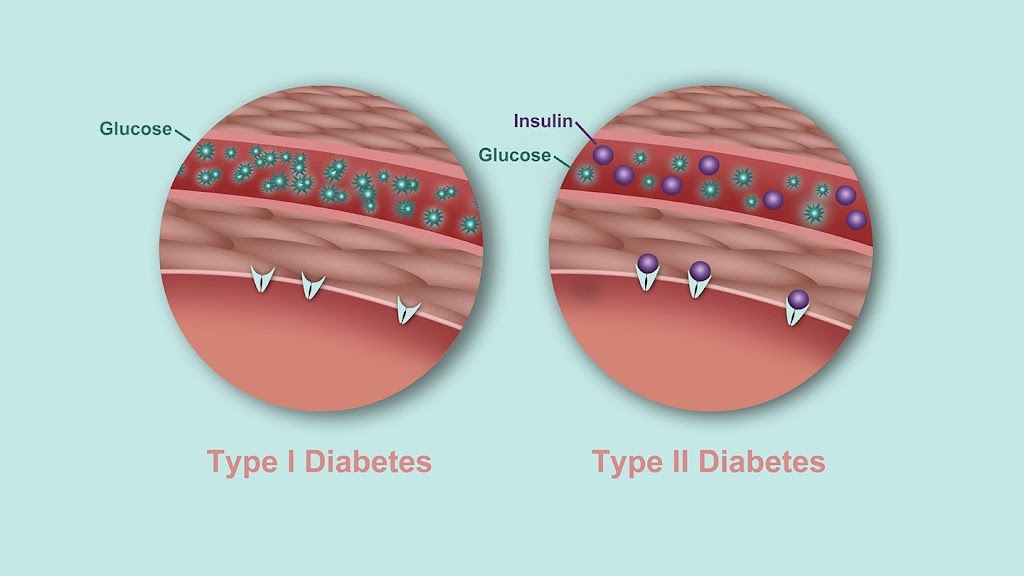 Type 2 Diabetes