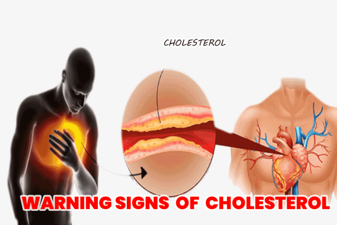 9 Warning Signs and Symptoms of High Cholesterol Should Never Ignore