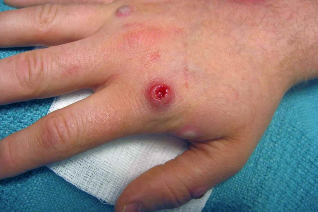 monkeypox-wound-on-hand-between-finger