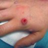 monkeypox-wound-on-hand-between-finger