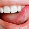 Canker Sores: Natural Home Remedies for Soothing Relief