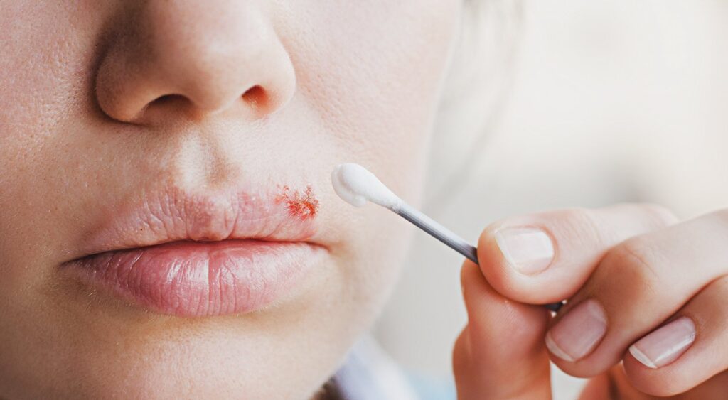 Conquering Cold Sores Effective Home Remedies for Quick Relief