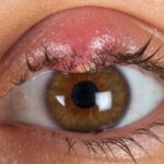 Eye Pimple Understanding Causes, Treatment, and Prevention