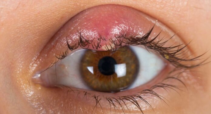 Eye Pimple Understanding Causes, Treatment, and Prevention