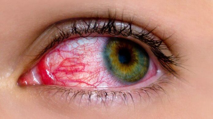 Clearing the Vision: Effective Home Remedies for Pink Eye Relief