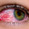 Clearing the Vision: Effective Home Remedies for Pink Eye Relief