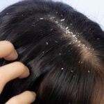 Bid Farewell to Flakes: Effective Home Remedies for Dandruff Relief