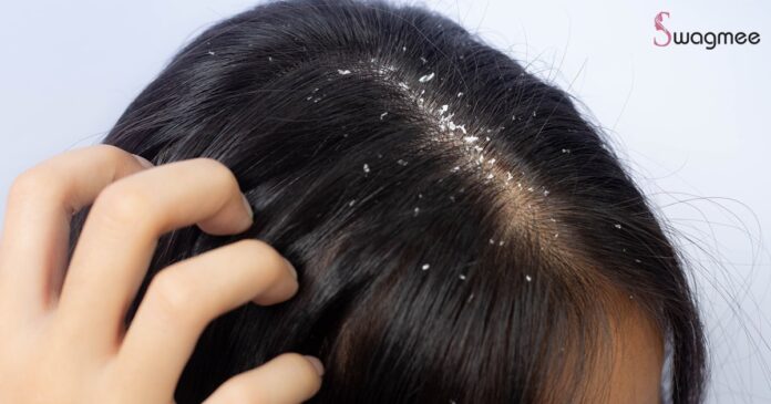 Bid Farewell to Flakes: Effective Home Remedies for Dandruff Relief