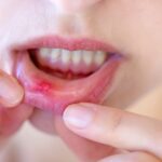 Healing the Pain: Effective Home Remedies for Canker Sores