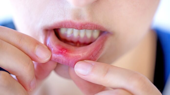 Healing the Pain: Effective Home Remedies for Canker Sores